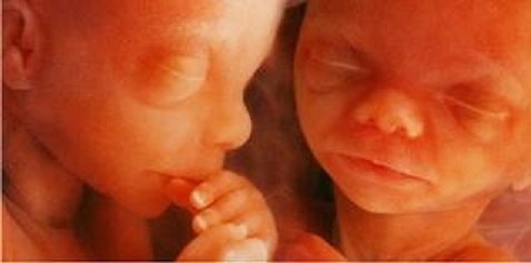 Twin fetuses