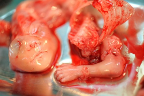ABORTION Dismemberment results