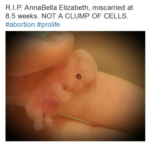 ABORTION not a clump of cells