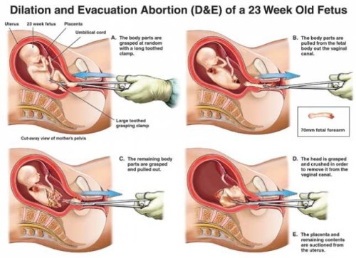 ABORTION Dismemberment