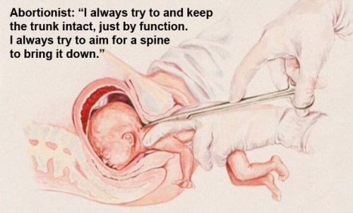 Partial birth abortion