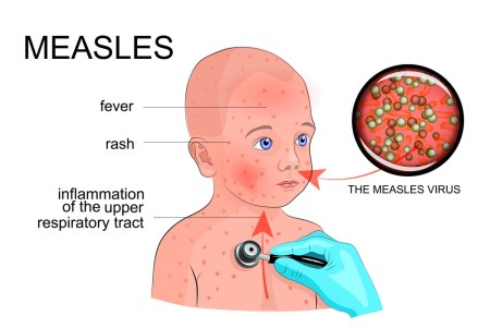 Measles