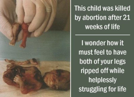 dismemberment victim