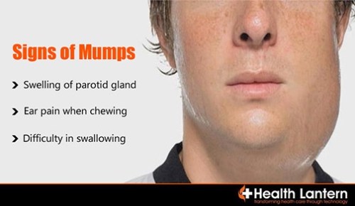 2020_02 29 mumps