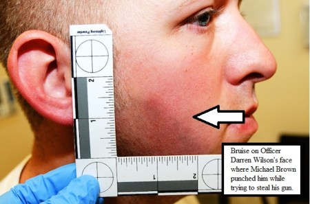 2020_08 02 Wilson's bruise